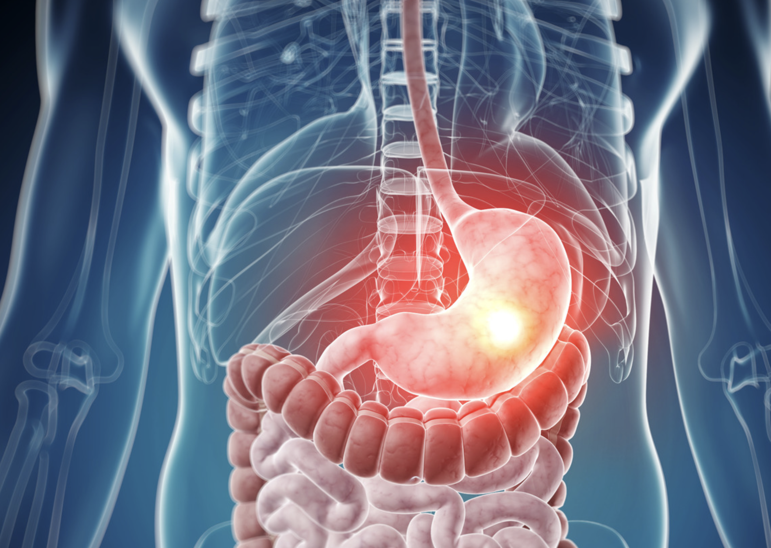 Gastrointestinal Stromal Tumor (GIST)